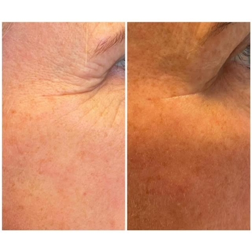 Før og efter 3 behandlinger