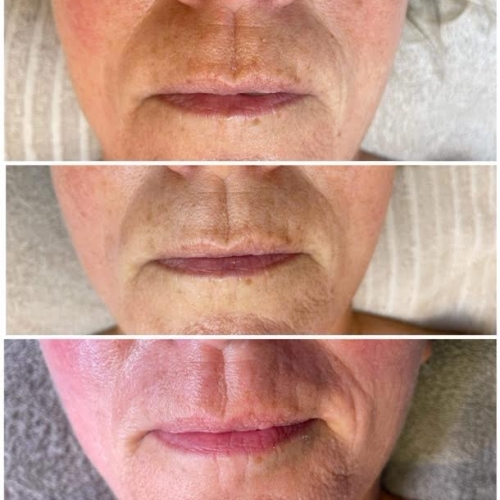 Efter 1. 2. og 3. behandling