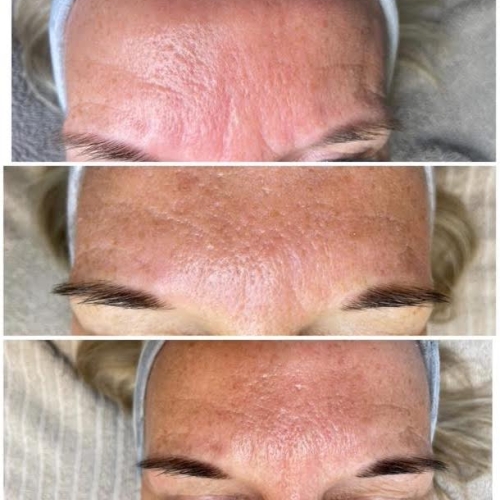 Efter 1. 2. og 3. behandling