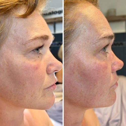 Før og efter 1. behandling