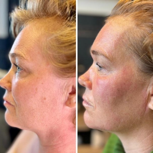 Før og efter 3. behandling