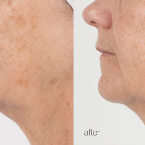 Før og efter behandling af pigmentering