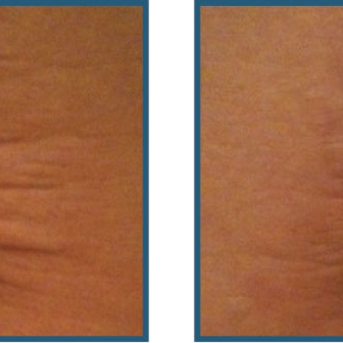 Før / efter Strækmærker, ar og slap hud