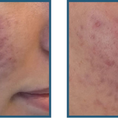 Før/efter – akne/acne – ar, pigmentering og inflammation