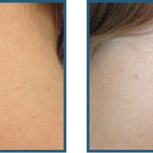 Før / efter sår, ar