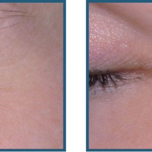 Før / efter – øjenomgivelser, fine linjer