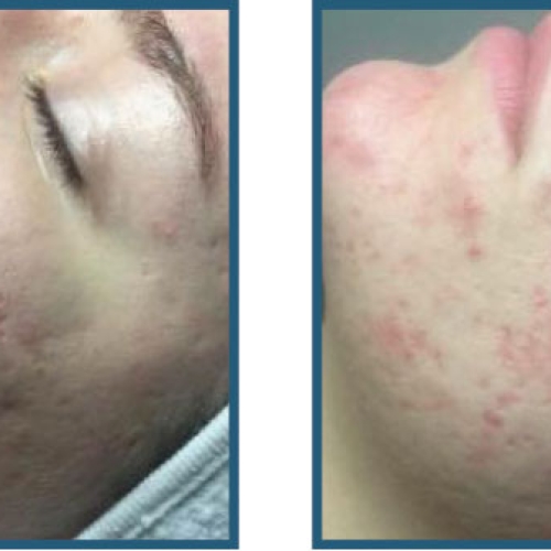 Før / efter – akne, udbrud, ar og inflammation