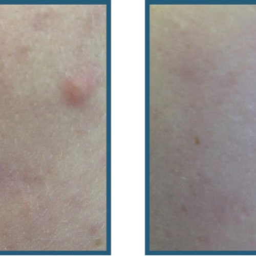 Før / efter – akne, ujævn struktur, udbrud og rødme