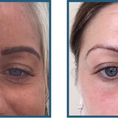 Før / efter – pigmentering