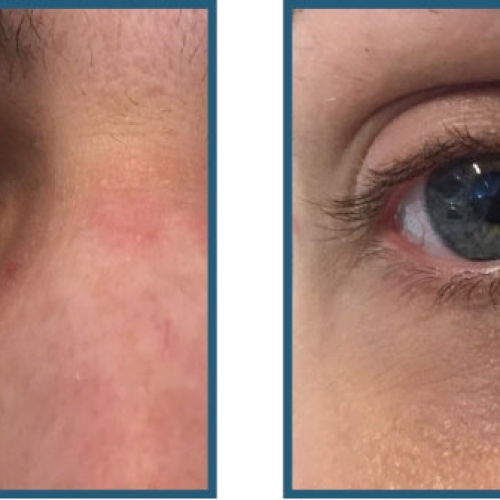 Før / efter – øjenomgivelser, mørke rande og poser under øjnene