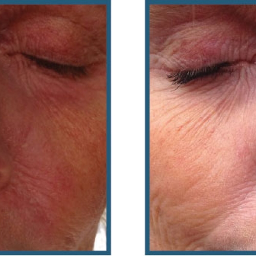 Før / efter hele ansigt – rynker og sart hud, eksem og rødme