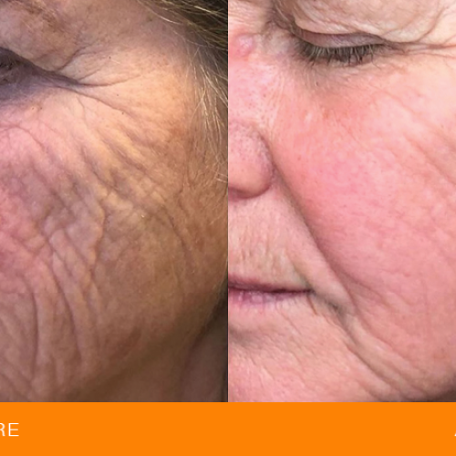 Før og efter behandling af rynker og linjer