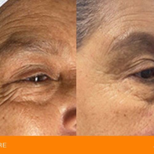 Før og efter behandling af rynker og linjer