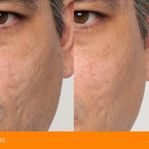 Før og efter behandling af arvæv