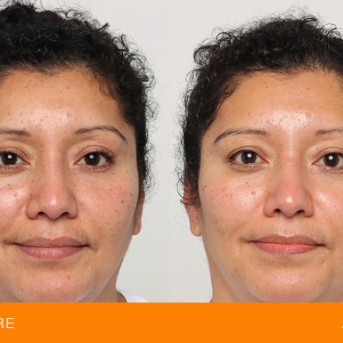 Før og efter behandling af pigmentering