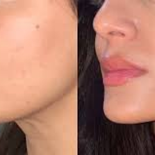 Før/efter Pro Dermaplaning Glass skin ansigtsbehandling