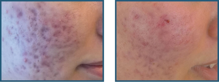 Før/efter – akne/acne – ar, pigmentering og inflammation