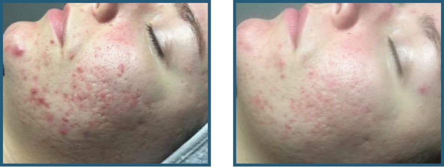 Før / efter – akne, udbrud, ar og inflammation