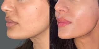 Før/efter Pro Dermaplaning Glass skin ansigtsbehandling